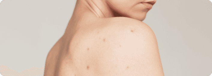 Pakiet badań hormonalnych na trądzik