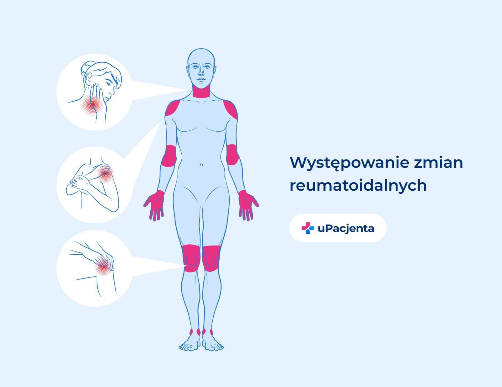 zmiany reumatoidalne