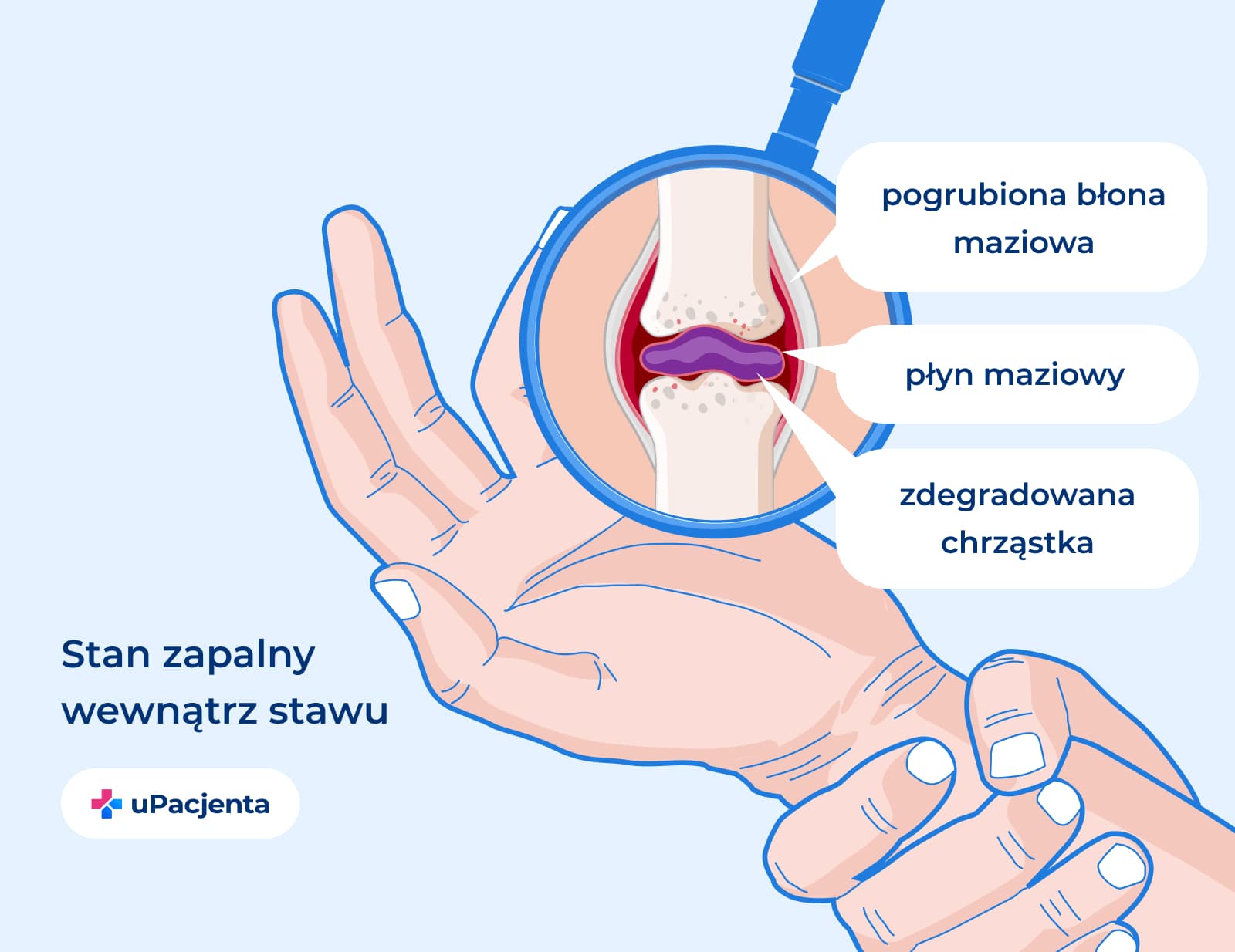 stawy dłoni - dlaczego bolą stawy