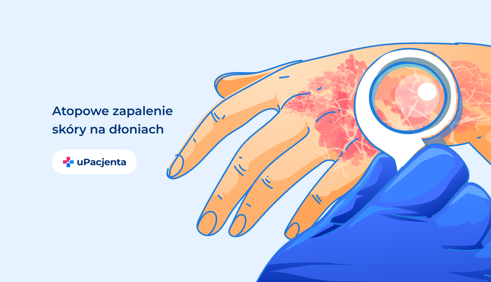 AZS dłonie. Grafika przedstawia atopowe zapalenie skóry na dłoniach.