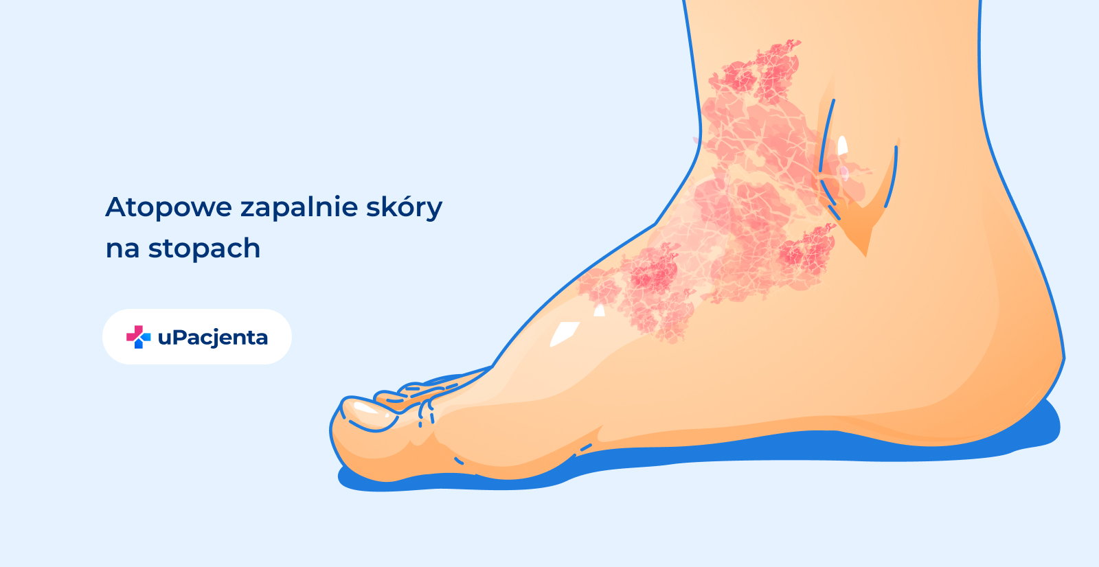 AZS stopy. Grafika przedstawia atopowe zapalenie skóry na stopach.