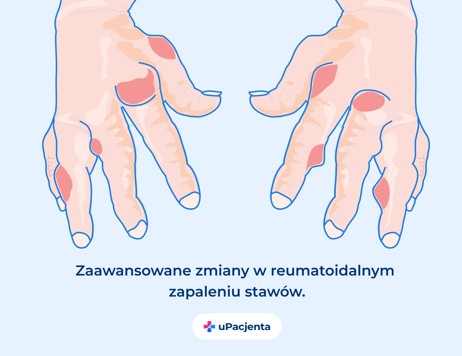 zwyrodnienie stawów rąk - choroby reumatyczne